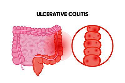 Ulcerative colitis Image