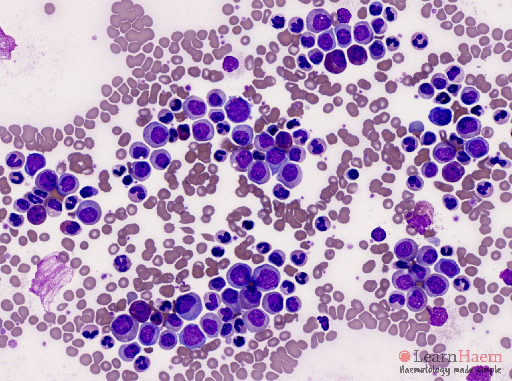 Chronic myeloid leukaemia Image