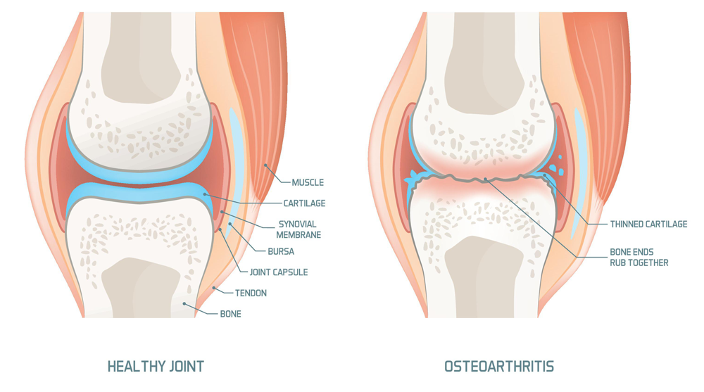 Osteoarthritis & degenerative arthritis Image