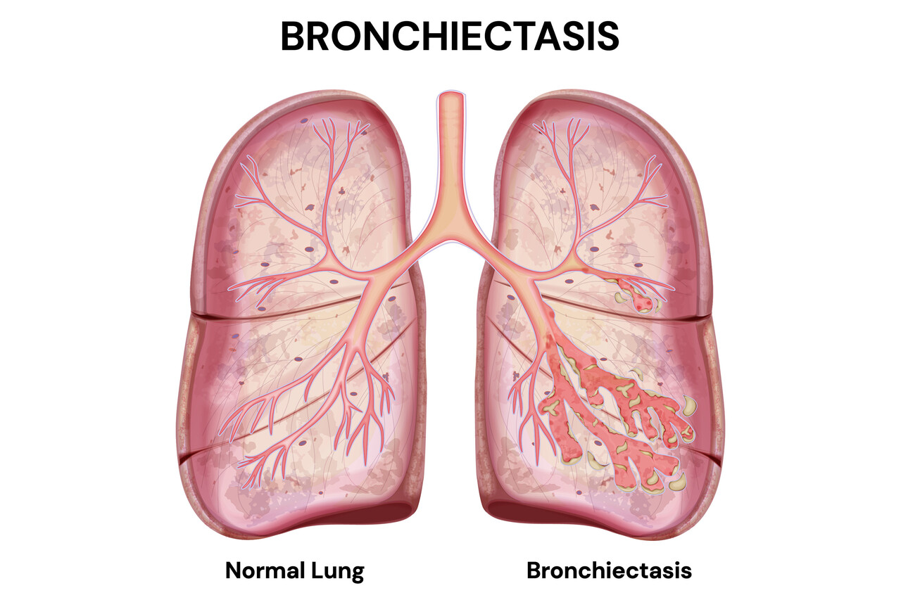 Bronchiectasis Image