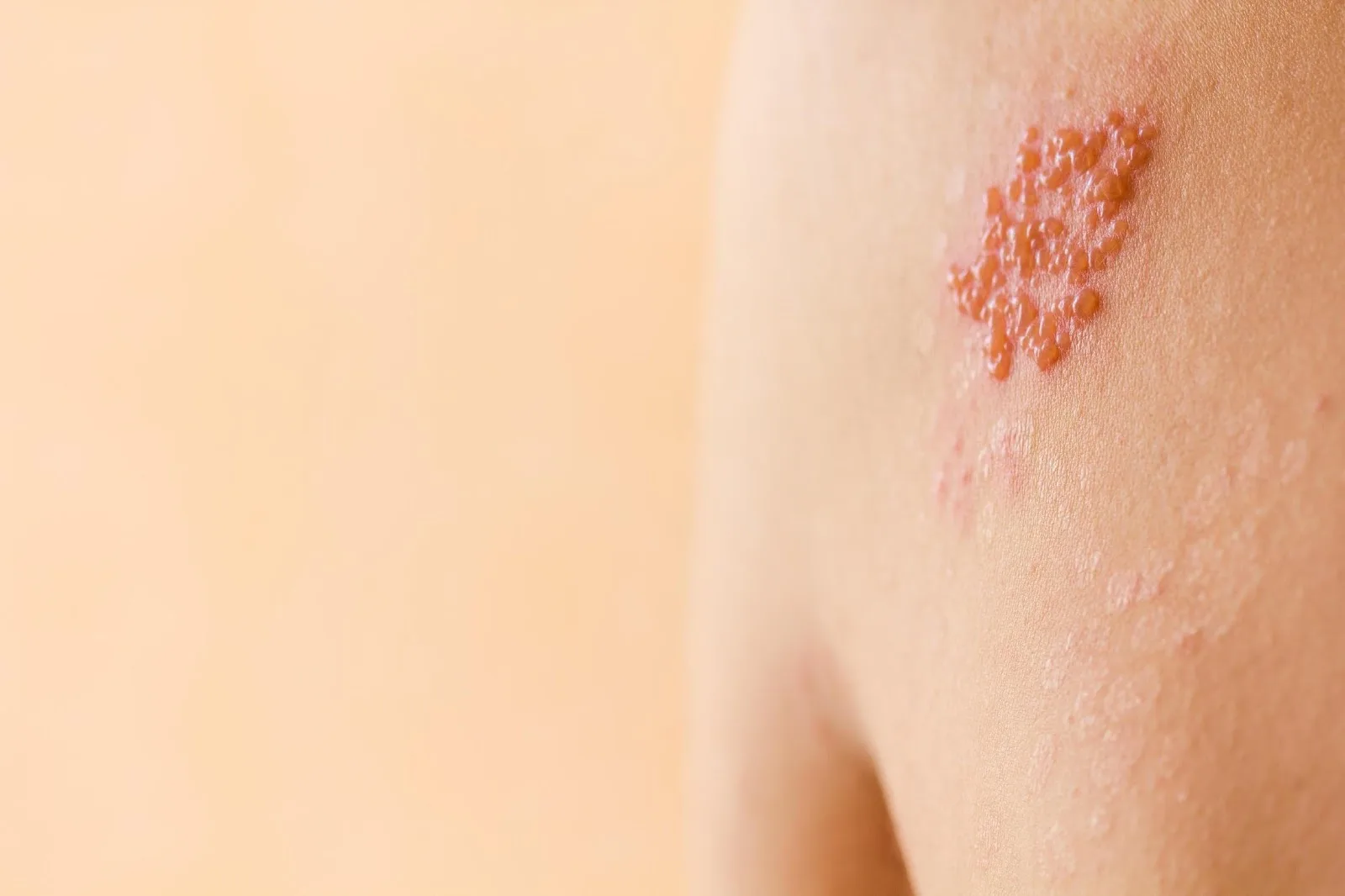 Herpes zoster (shingles) Image
