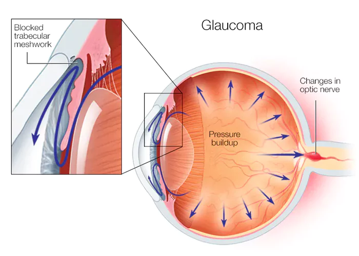 Open-angle glaucoma Image