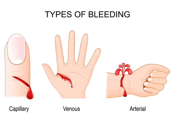 Capillary bleeding Image