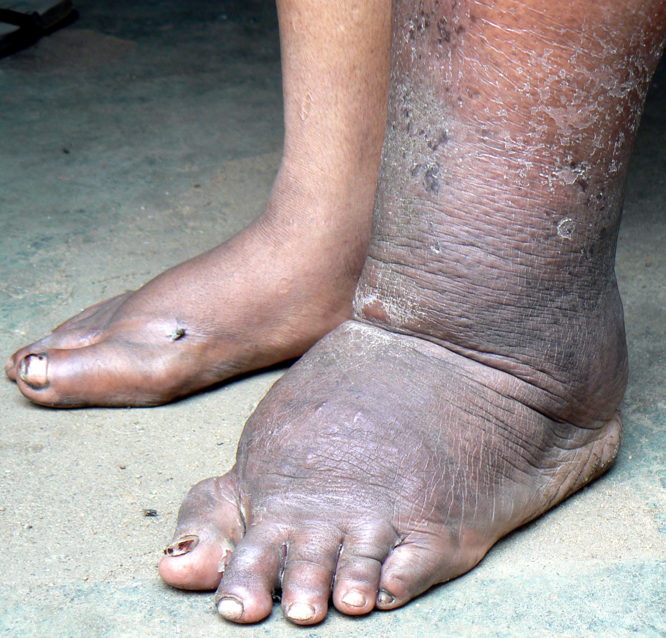Filariasis Image