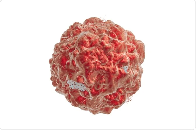 Tumor lysis syndrome Image
