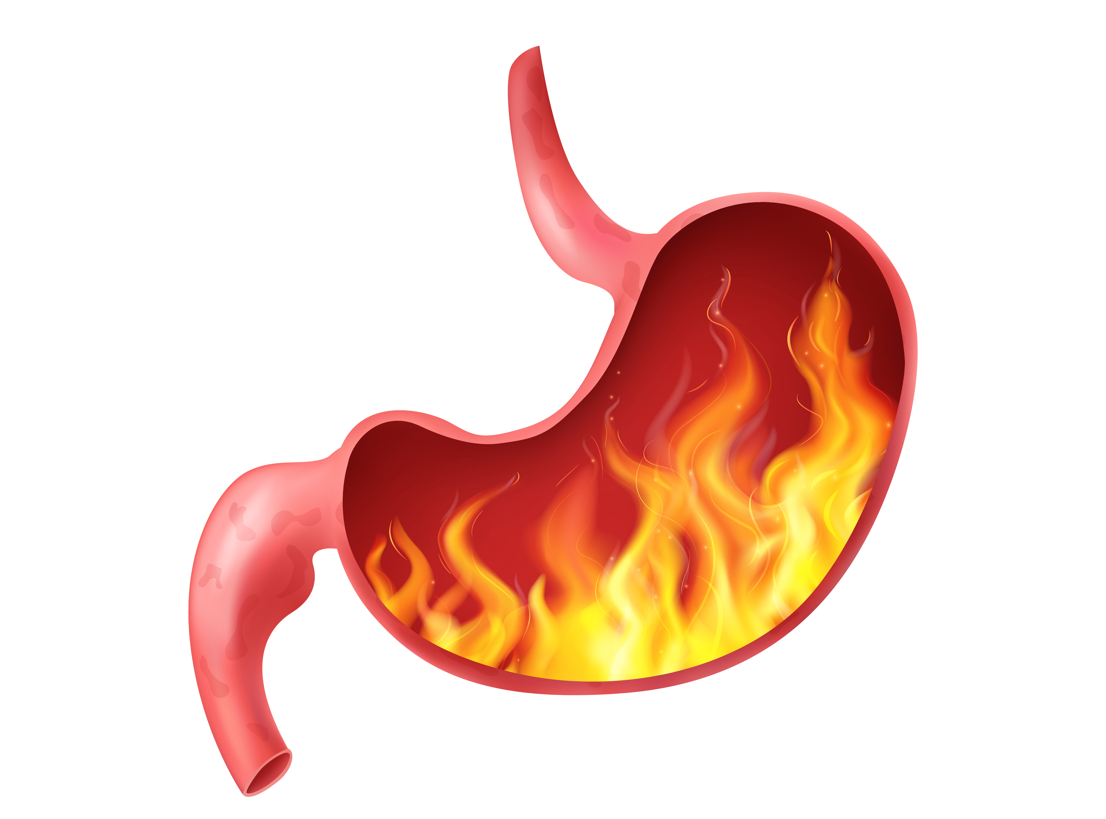 Gastric Hyperacidity Image