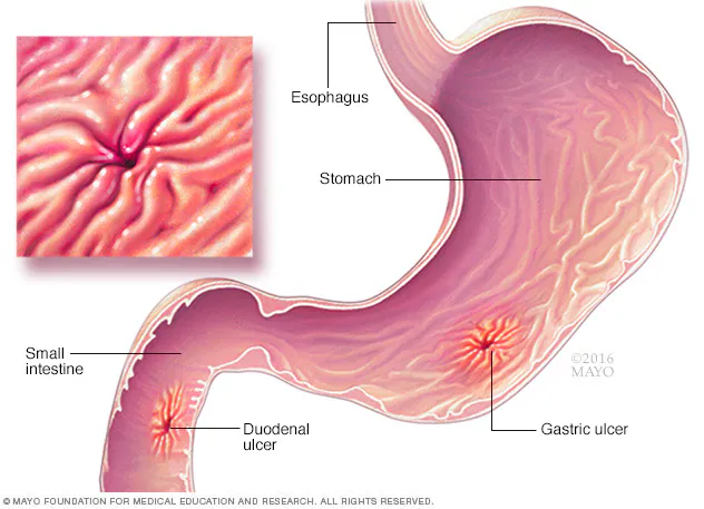 Gastric ulcer Image