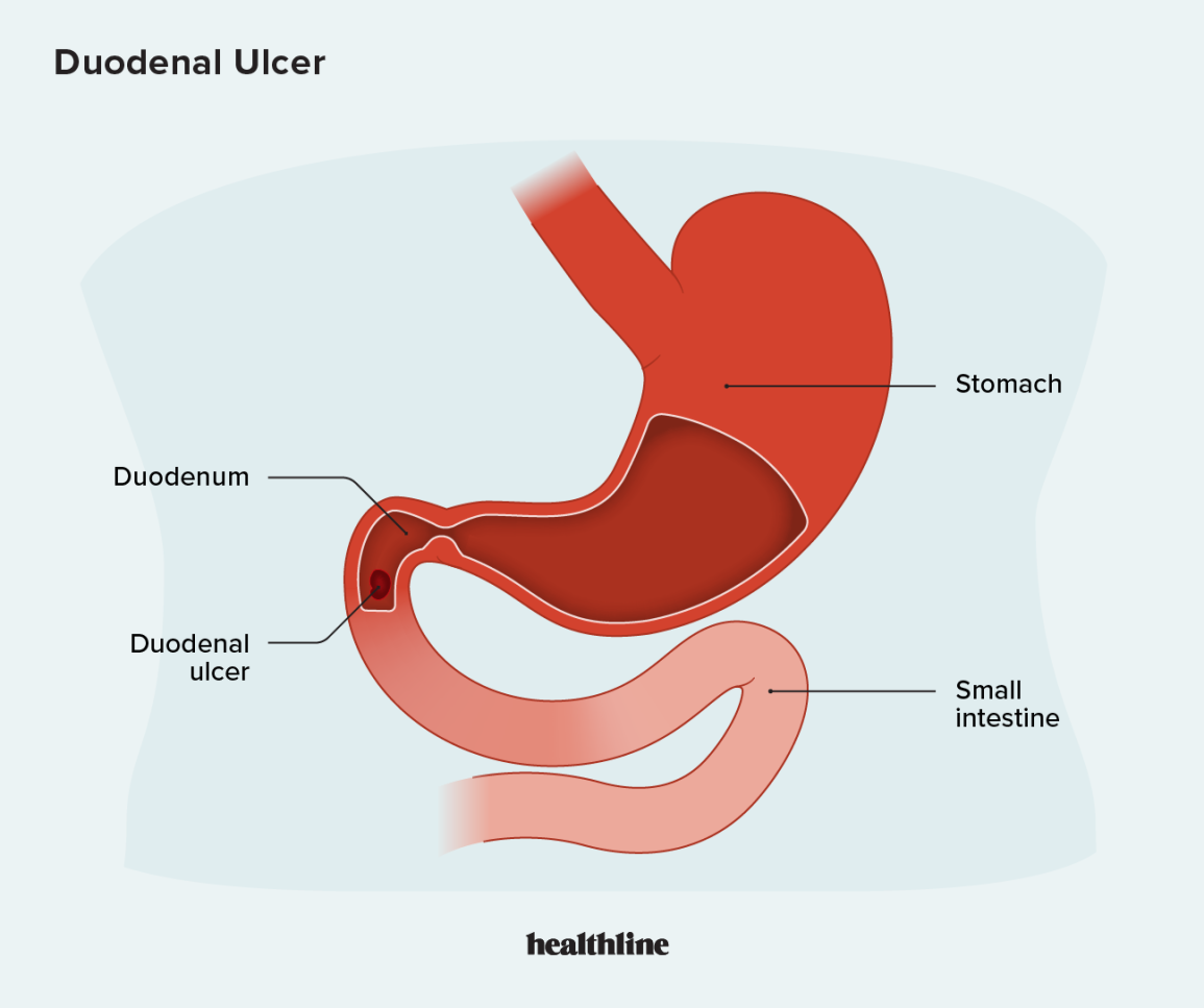 Duodenal ulcer Image