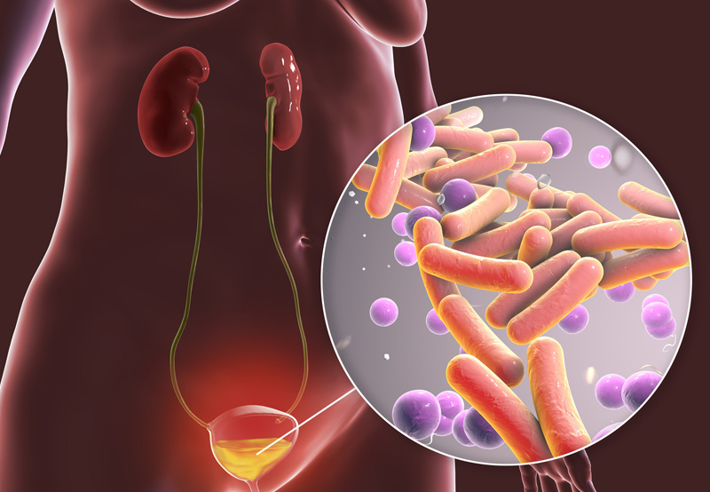 Complicated and recurrent urinary tract infections Image