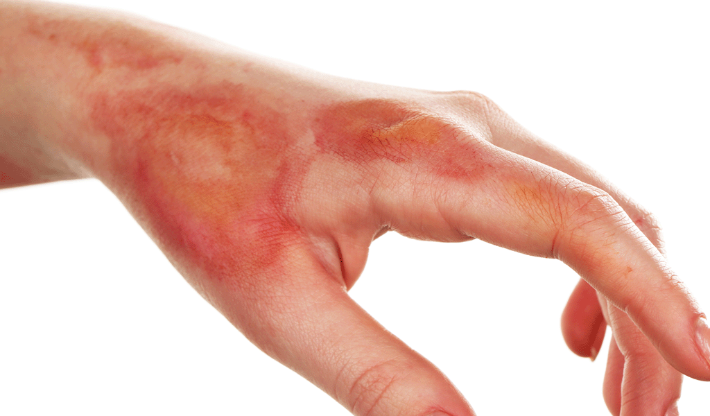 Burns Image