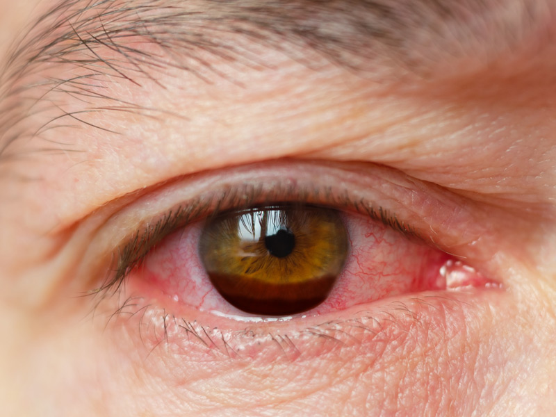 Traumatic hyphema Image