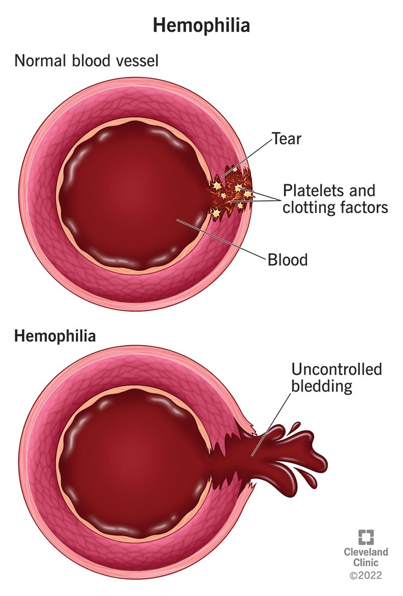Hemophilia A Image