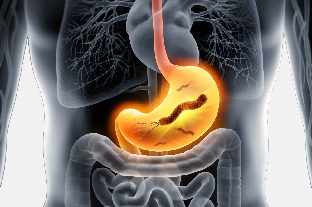 H. pylori infection Image