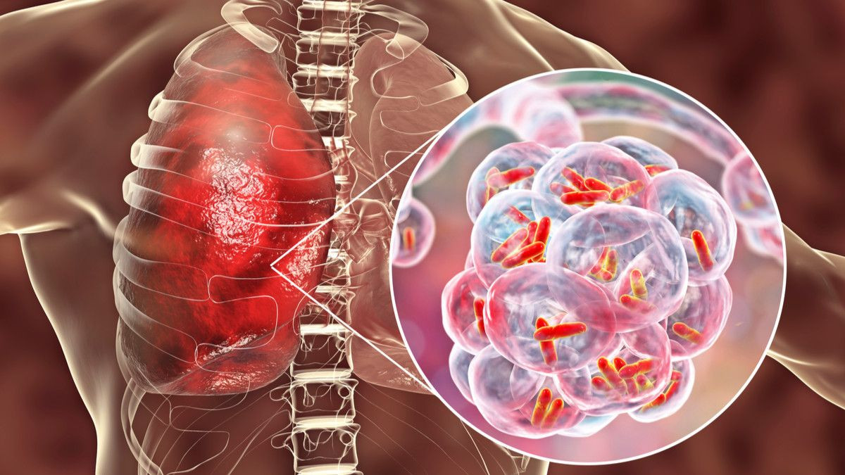 Community-acquired pneumonia Image