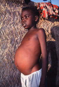 Visceral leishmaniasis Image