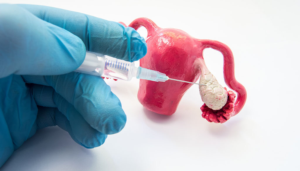 Ovulation induction Image