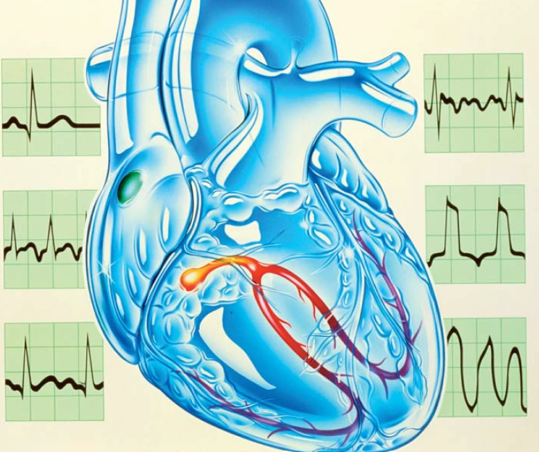 Arrhythmias Image