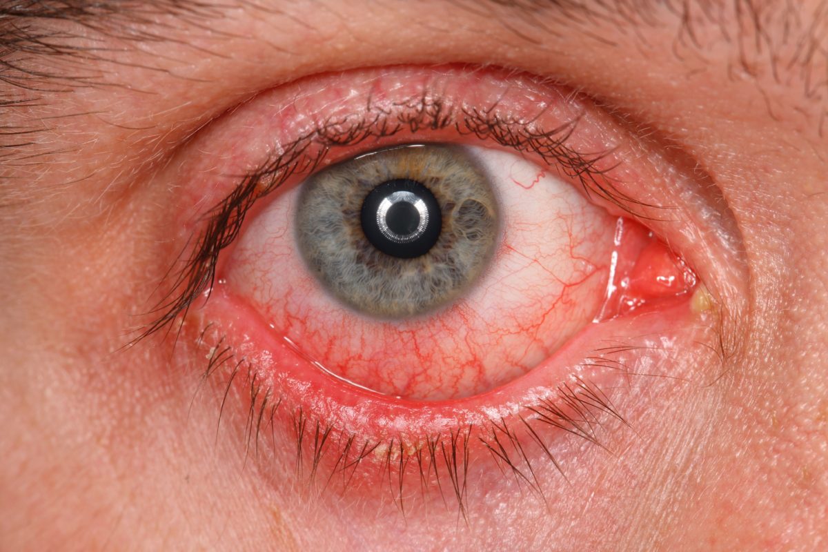 Inflammatory eye disorders Image