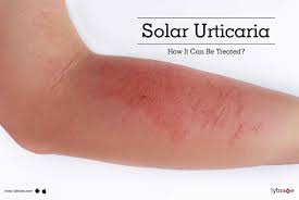 Solar urticaria Image