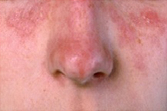 Acute lupus erythematosus Image