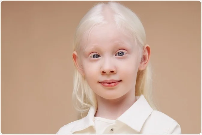 Cutaneous albinism Image