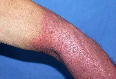 Drug-induced photosensitivity Image