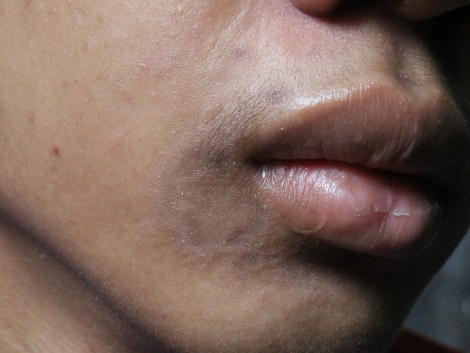 Post inflammatory hyperpigmentation Image