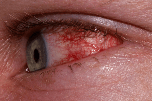 Allergic conjunctivitis Image