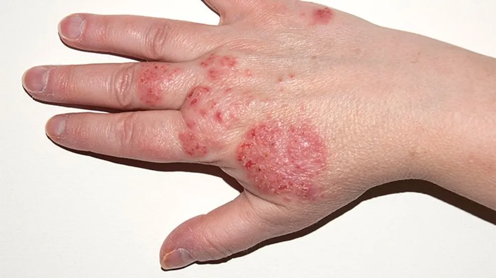 Eczema Image