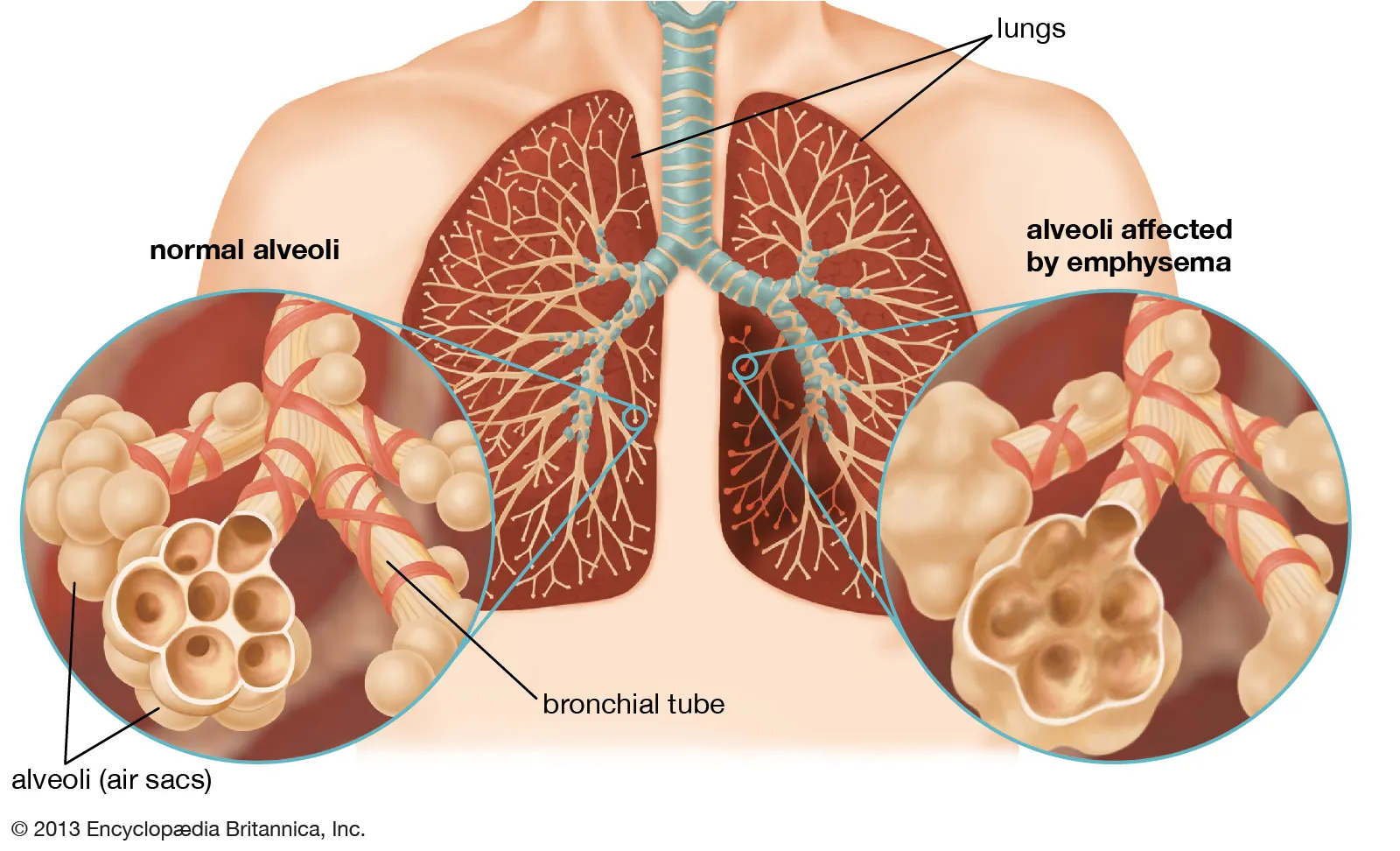 Chronic obstructive pulmonary disease (COPD) Image