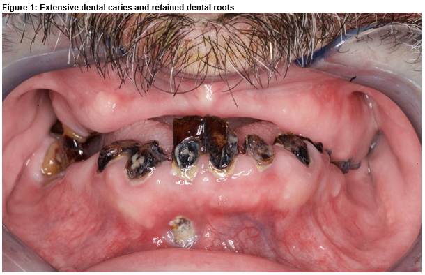 Fusobacterium infections Image