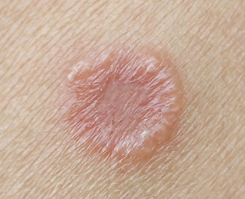 Fungal infections Image