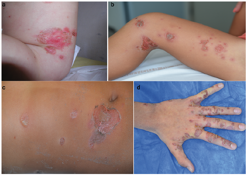 Infections caused by Staphylococcus (susceptible strains) Image