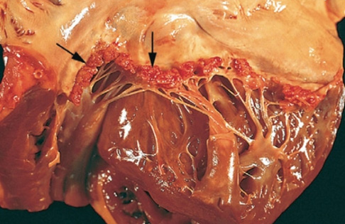 Subacute bacterial endocarditis Image