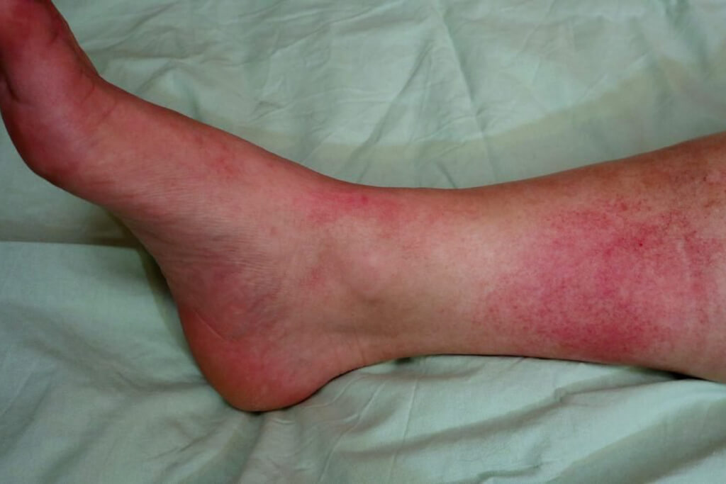 Skin and soft tissue infections Image