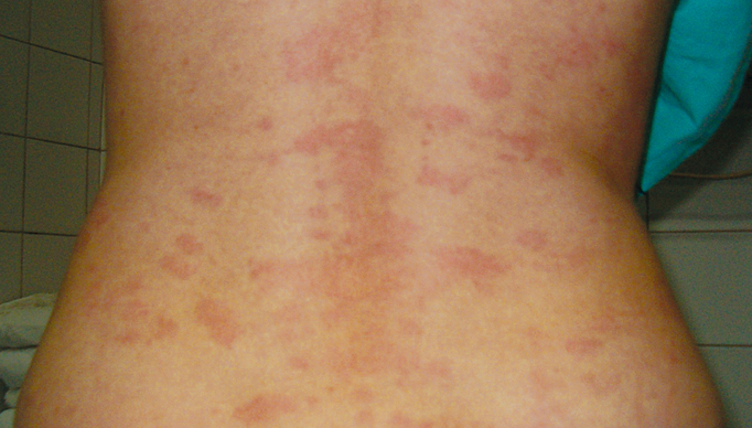 Serum sickness Image