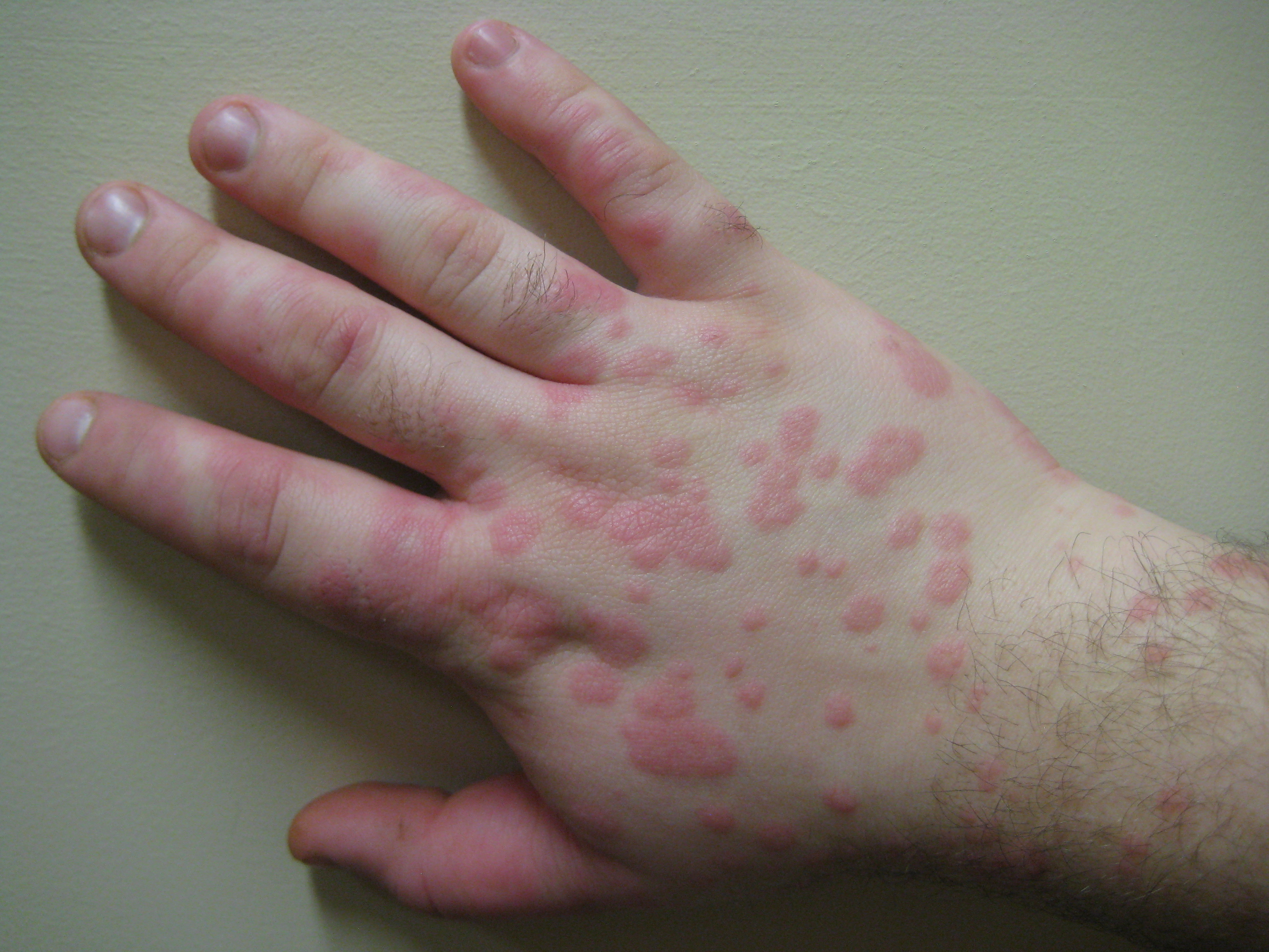 Severe erythema multiforme (Stevens-Johnson syndrome) Image