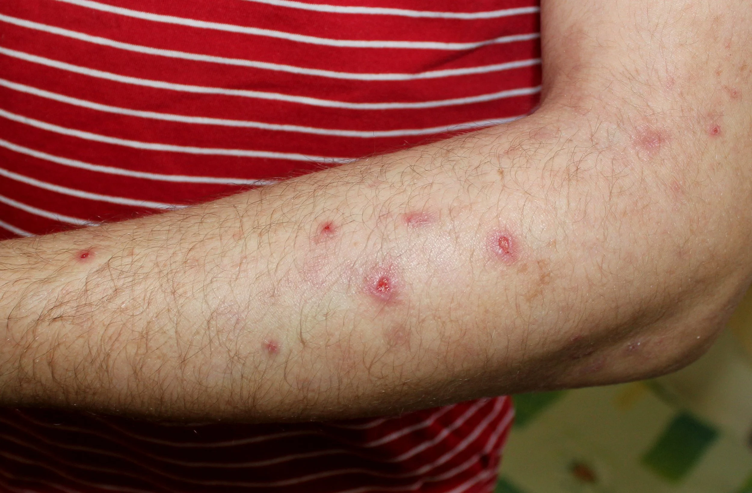 Prurigo nodularis Image