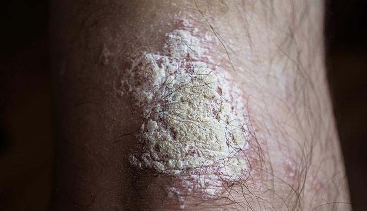 Plaque psoriasis Image
