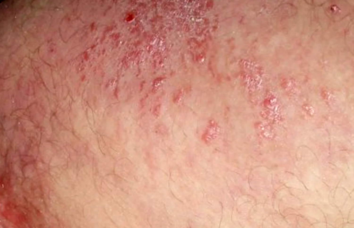 Jock itch Image