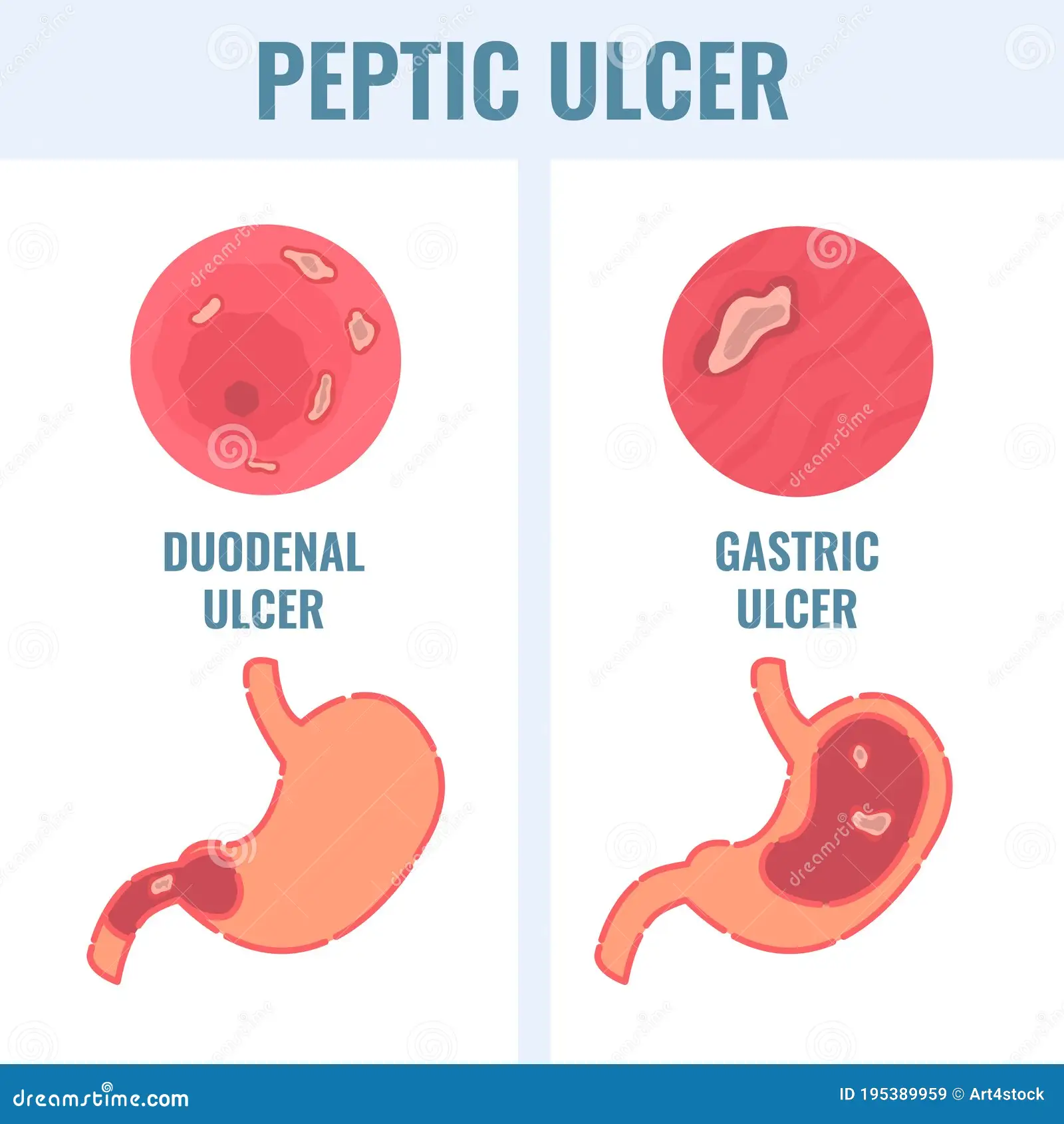 Gastric and duodenal ulceration Image
