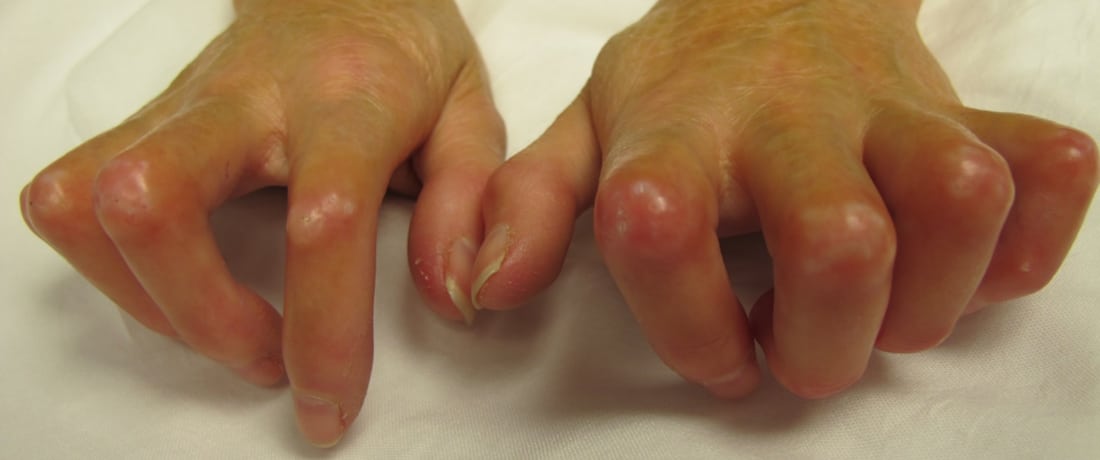 Systemic sclerosis Image
