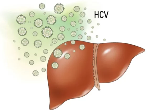 Hepatitis C