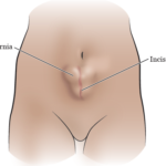 incisional hernia