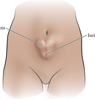 incisional hernia
