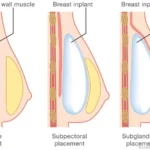breast surgery procedures