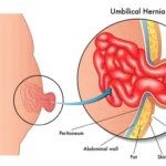 Which is best surgery for hernia?