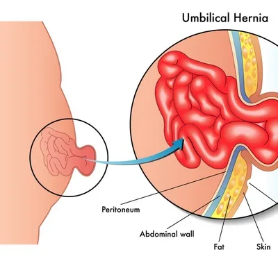 Which is best surgery for hernia?