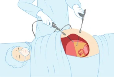 What is hernia repair surgery in female?