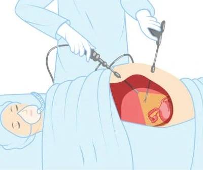 What is hernia repair surgery in female?